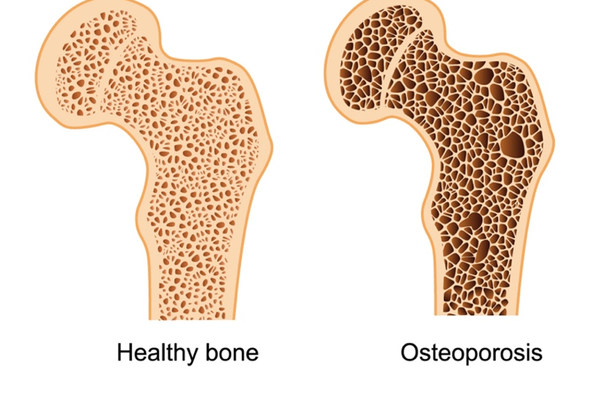 Osteoporosis – An Invisible Disorder