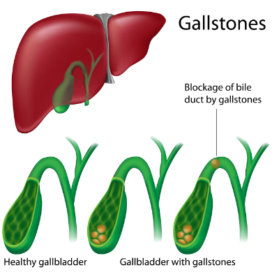Silent Stones with Growing Pains: Gallstones